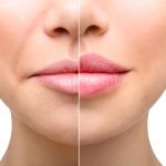 thumbnail of Enjoy Beautiful Fuller Lips